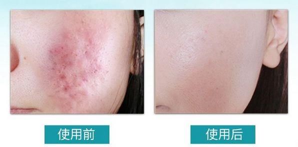 整容遭报应?她的少女脸这么快就烂了?