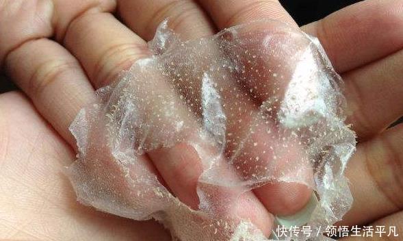 『白色东西』鼻子上挤出来的白色物体是什么皮肤科医生给出这些忠告