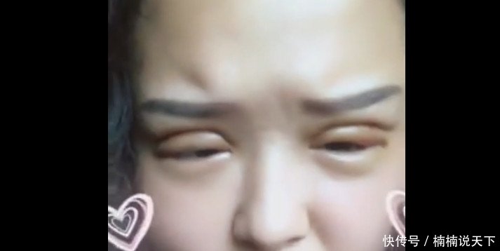 刚割完双眼皮的脸，你确定是在变美让人有些不忍直视！