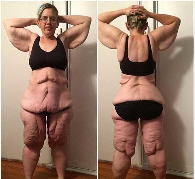 女子通过手术减肥260斤，然而后遗症却让她后悔终身！