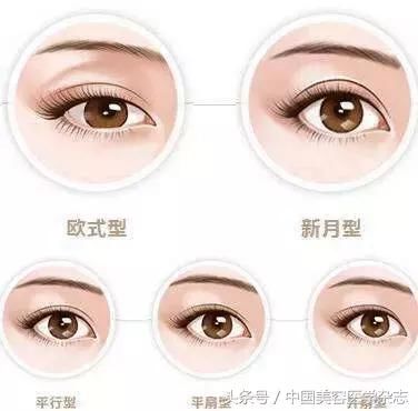 你真的适合“欧式”双眼皮吗？