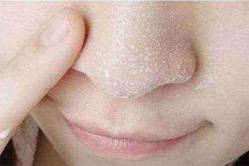 鼻子周围有很多“小黑点”，一挤还有白色的“米粒”，是怎么回事