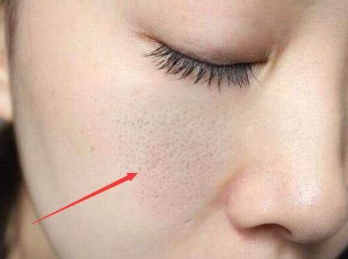 毛孔粗大是因为螨虫挤大，3方法有效除螨，排空毛孔螨虫