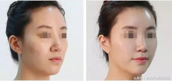 苹果肌和高颧骨之间有超大区别，你分得清楚吗？