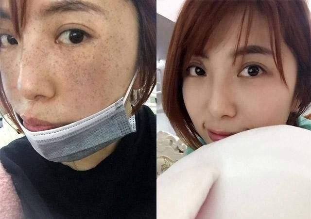 青青一根“它”祛斑胜过激光仪，睡前擦下脸，三天肌肤雪嫩似婴儿