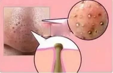 开口闭口粉刺，识别黑头白头……了解这些你冒痘的脸还有得救！