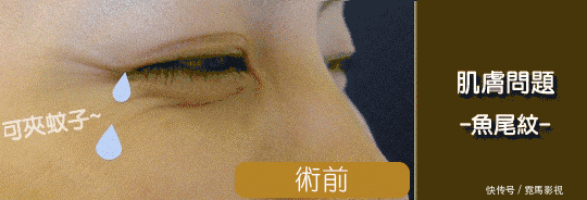 『除皱原理』玻尿酸解决静态皱纹,肉毒素对付动态皱纹,你适合哪个?