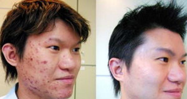 「解决」药店有款男士洗面,网友为买它日夜排队,3次解决痘痘肌问题