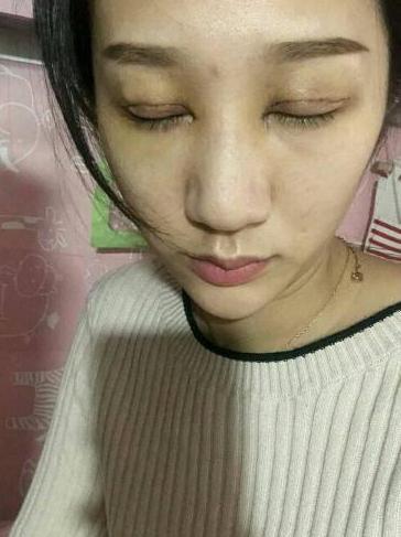 切开双眼皮真实案例分享，眼睛变大变有神了