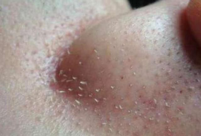 鼻子上黑头粉刺鼓鼓囊囊？用3招不撕不挤，黑头粉刺“如雨落下”