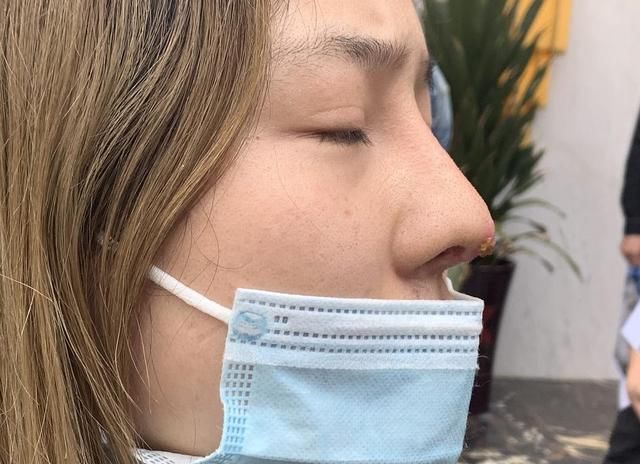  [隆鼻手术]俩女子隆鼻一个呼吸不畅一个假体顶出来！美容医院：类似的挺多…