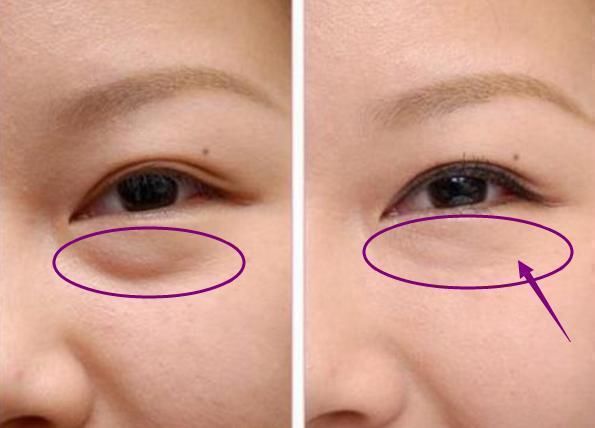 眼袋下垂就打玻尿酸?别傻!屈臣氏有个“黑科技”，2分钟没眼袋