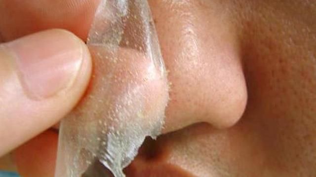 鼻头里的白条是螨虫吗?看这里,1眼辨别!