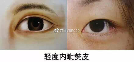  【内眦赘皮矫】需不需要看眼角……请对号入座