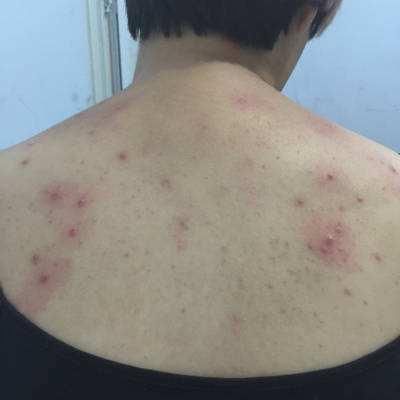 后背螨虫超级多？只要1勺盐，不到一毛钱，螨虫全部死光光！