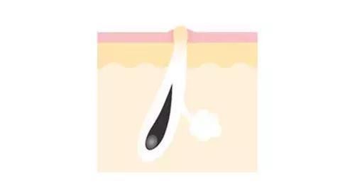 挤鼻子上的“小白点”时，挤出一个白色的长条是什么?