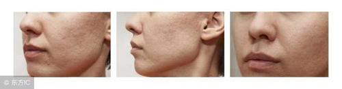 螨虫天天在脸上打洞,用这1招,脸蛋变得白白净净,开开心心等待开学