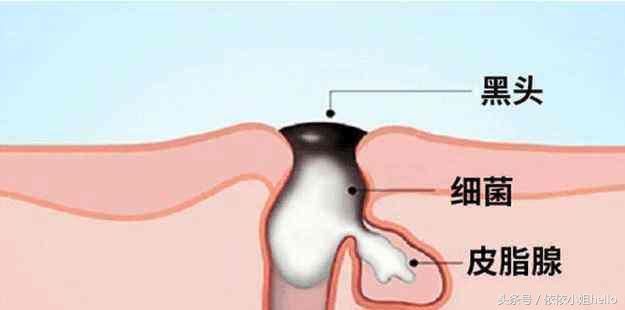 为什么你的黑头越去越多？怎么样去黑头才是正确的呢？