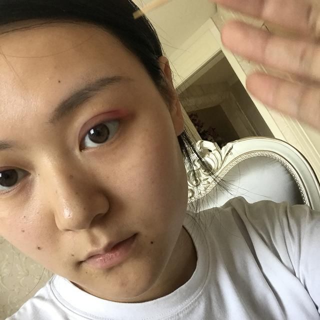 韩式双眼皮+开眼角能做出“桃花眼”吗？这篇真人案例值得参考！