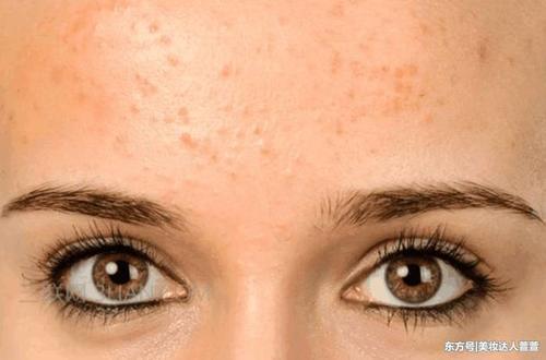 3个损害出现脸上,说明皮肤遭受螨虫摧残,只需用到2招可排空