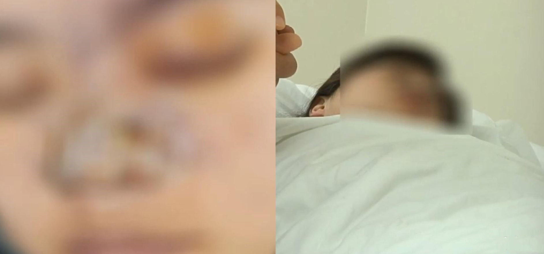 鼻子@女子注射玻尿酸,一针下去左眼失明、鼻子烂掉!接着病危送进ICU