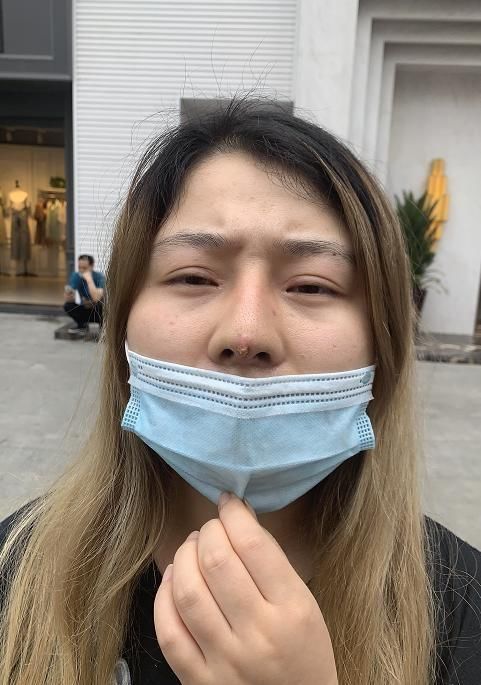  [隆鼻手术]俩女子隆鼻一个呼吸不畅一个假体顶出来！美容医院：类似的挺多…