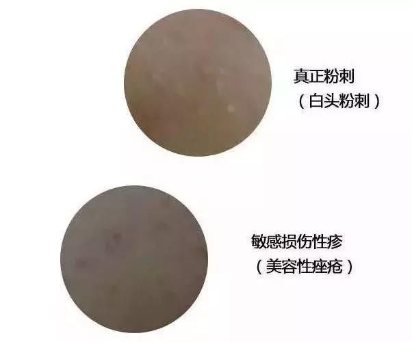 开口闭口粉刺，识别黑头白头……了解这些你冒痘的脸还有得救！