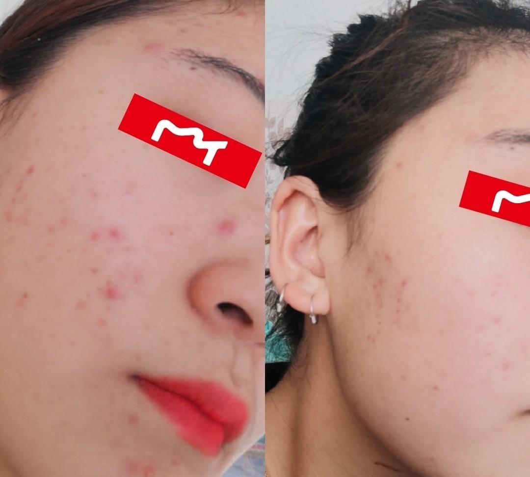  小妙：脸上长痘不慌张，4个贴心小妙招，助你轻松祛痘不留痕