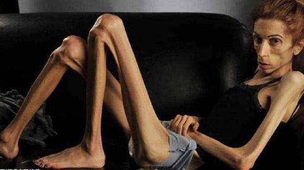 国外一女子从120斤瘦到了30斤,真的是瘦成了一道闪电