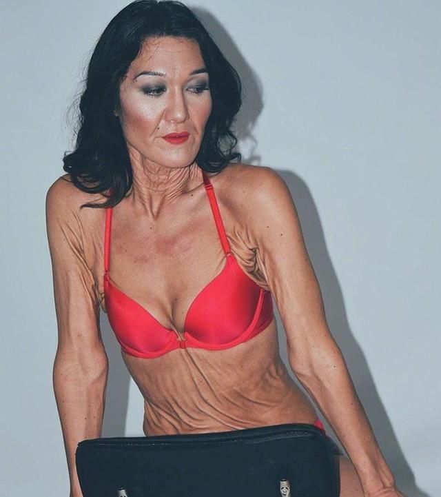 惊呆！26岁女孩患病皮肤松弛如奶奶，网上晒照：做自己！