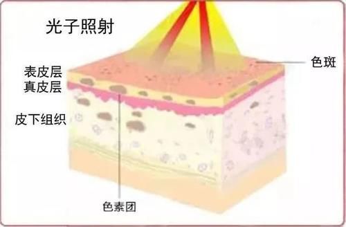  『皮肤』光子嫩肤\OPT值得尝试吗？为什么要在医院弄？