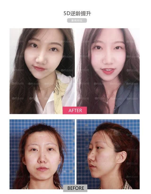  「填充苹果肌」看起来显老，问题可能出在苹果肌