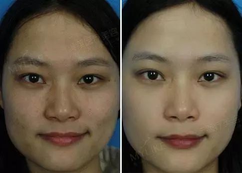 「黄瓜」黄瓜敷脸美白还有用吗?还是来支水光针吧!