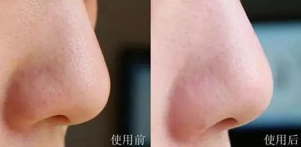 小清新的“脸部吸尘器”，10分钟铲掉你脸上黑头、粉刺、角质!