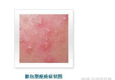  「正确」如何正确的祛痘痘