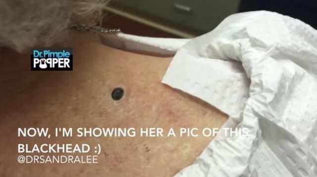 女子陪男友去医院挤黑头,拔出来的黑头让人看