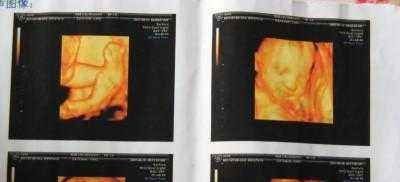 做四维彩超检查@孕期,做“四维彩超”时能看出宝宝性别或许聪明孕妈都能看明白