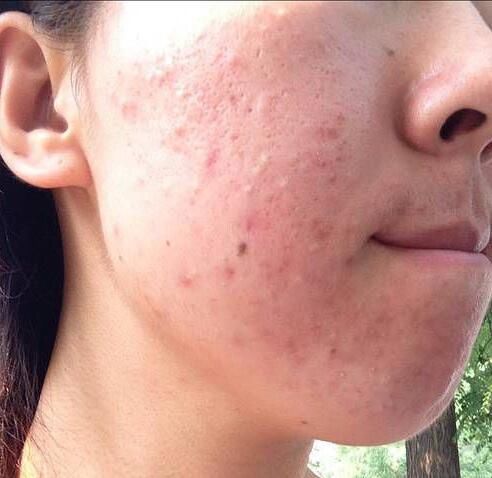 鼻头里挤出这么多“小黄粒”,证明脸上螨虫过亿，3招教你逼退螨虫