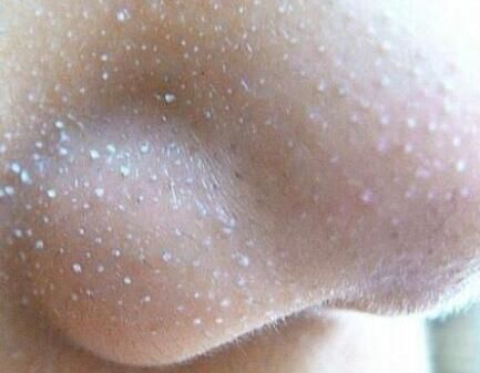 鼻子总是有“白色颗粒”冒出头?可能是螨虫在作怪哦