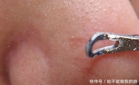  「技巧」鼻子爱出油黑头多，五个技巧清洁鼻子，黑头消失，毛孔也会变细