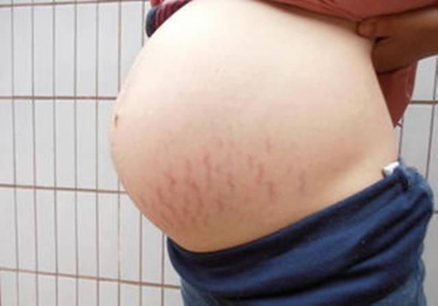  宝宝■孕晚期是胎宝宝“猛长期”，也是妊娠纹高发期，宝妈要学会预防