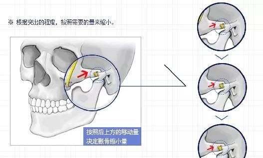  「颧弓」面部轮廓整形之“颧骨颧弓”