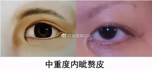  【内眦赘皮矫】需不需要看眼角……请对号入座