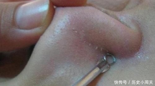 『鸡蛋』鼻子上挤出“白色条状物”?学会这3招,或与“草莓鼻”说拜拜呦!