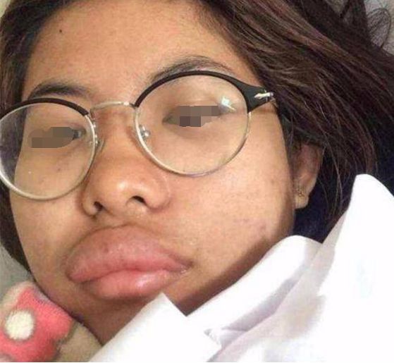 女子一觉醒来，嘴唇竟变成了“香肠”，检查后连医生都忍不住笑了