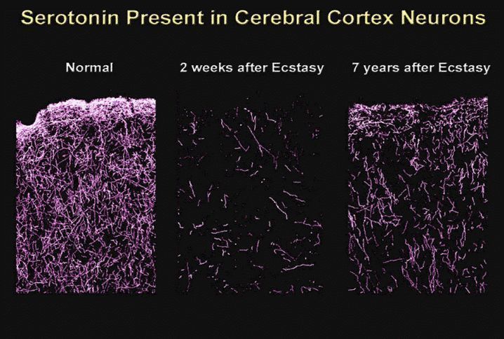 阳泉禁毒:合成毒品对大脑中枢神经的损害不可