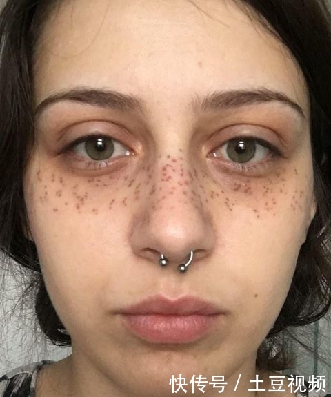 『手术』英女子痴迷梅根“雀斑妆”，拙劣手术让面部毁容，花3万治疗修复