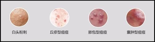  #营养#循证营养：痘痘肌该怎么吃？