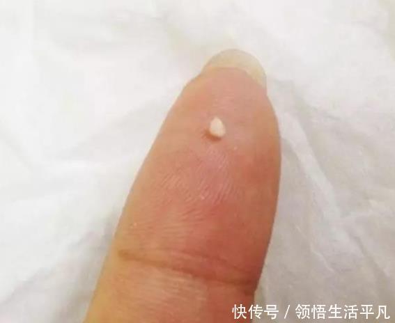  『白色东西』鼻子上挤出来的白色物体是什么皮肤科医生给出这些忠告