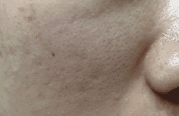 脸上出现这3个信号，暗示螨虫出击了，1种盐堪称螨虫“吸尘器”